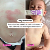 Before and after comparison of a child's skin with a tube of cream labelled 'Noody Calm Balm'.