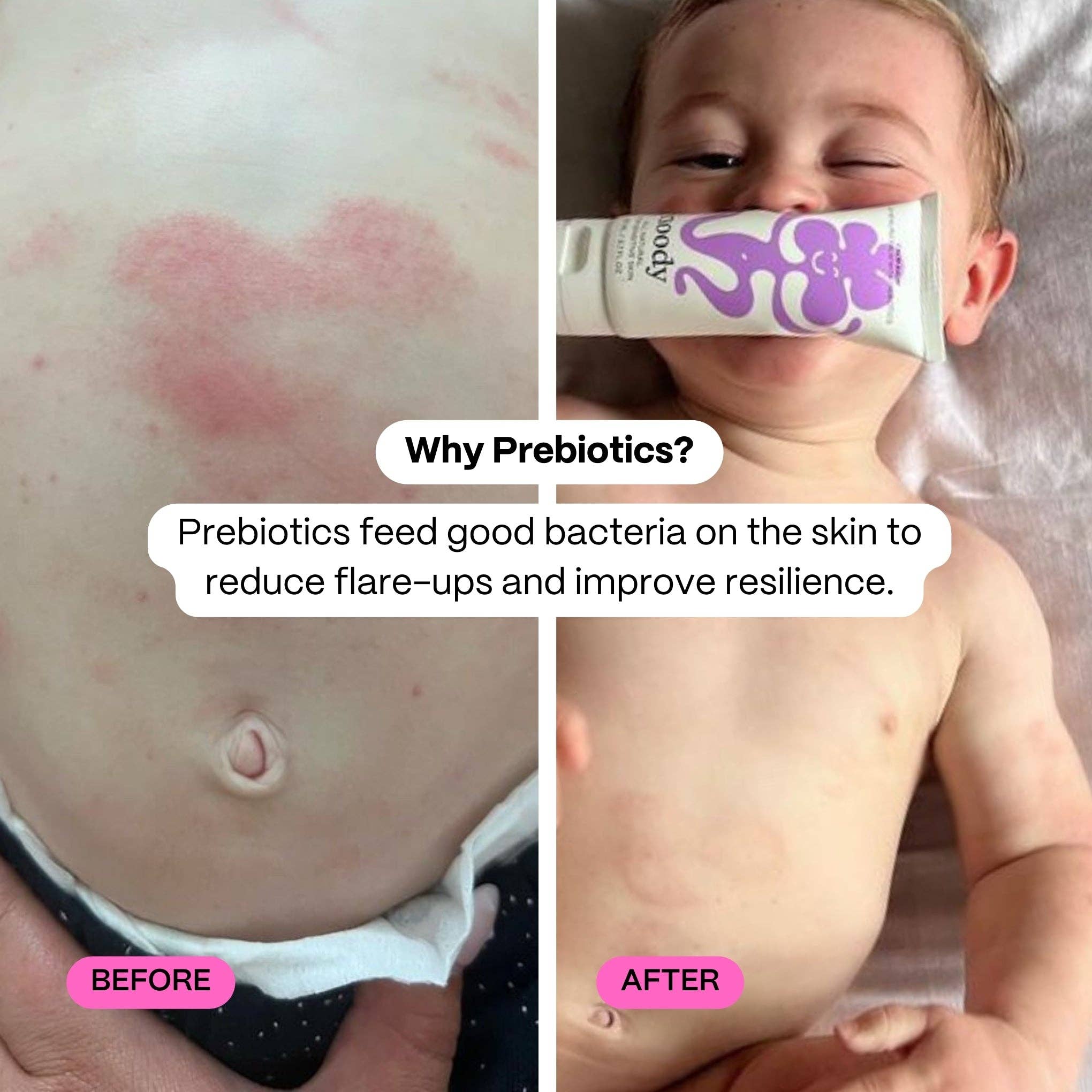 Before and after comparison of a child's skin with a tube of cream labelled 'Noody Calm Balm'.
