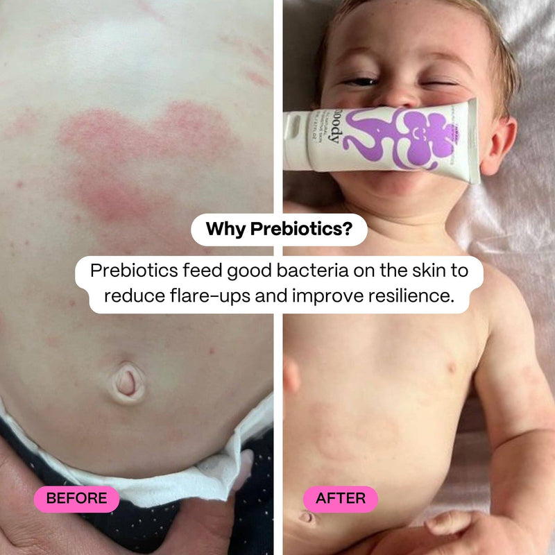 Before and after comparison of a child's skin with a tube of cream labelled 'Noody Calm Balm'.